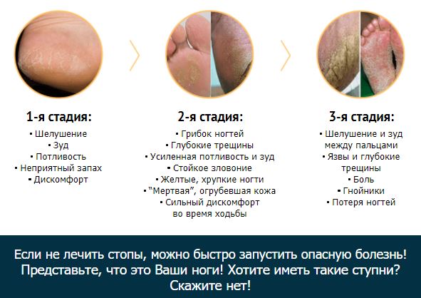 лечение грибка ногтей ног отзывы